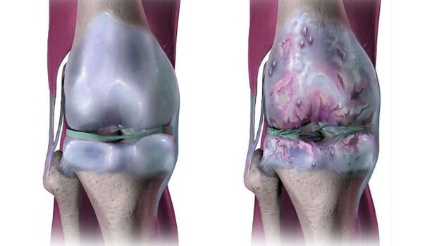 Здрава колянна става и засегната от артроза