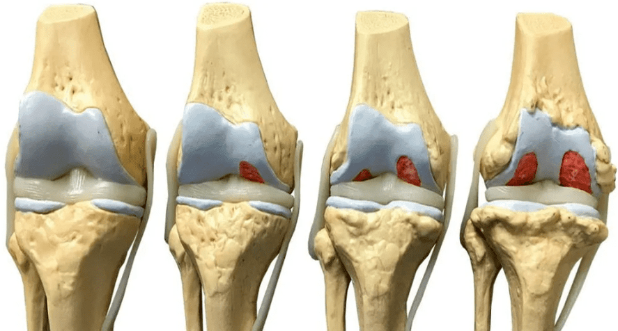 увреждане на колянната става на различни етапи от развитието на артроза