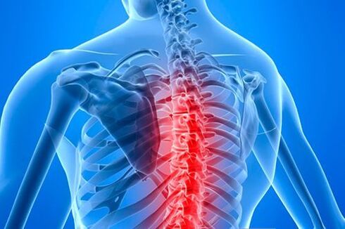 гръбначна лезия в случай на гръдна остеохондроза