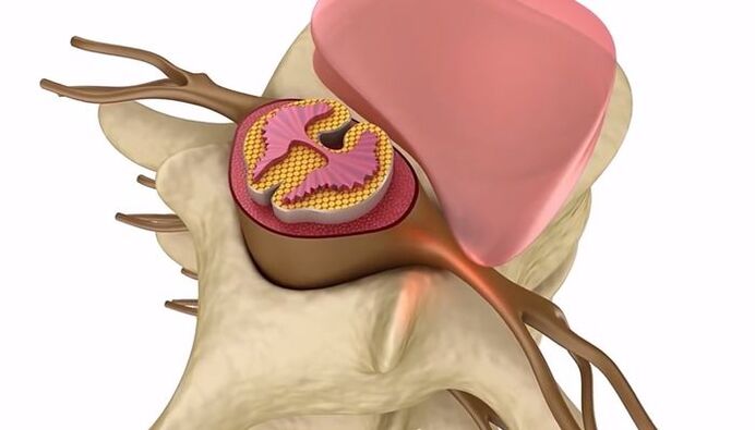 нараняване на гръбначния стълб при гръдна остеохондроза