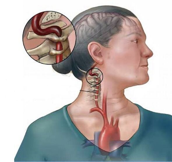 синдром на вертебралната артерия с цервикална остеохондроза