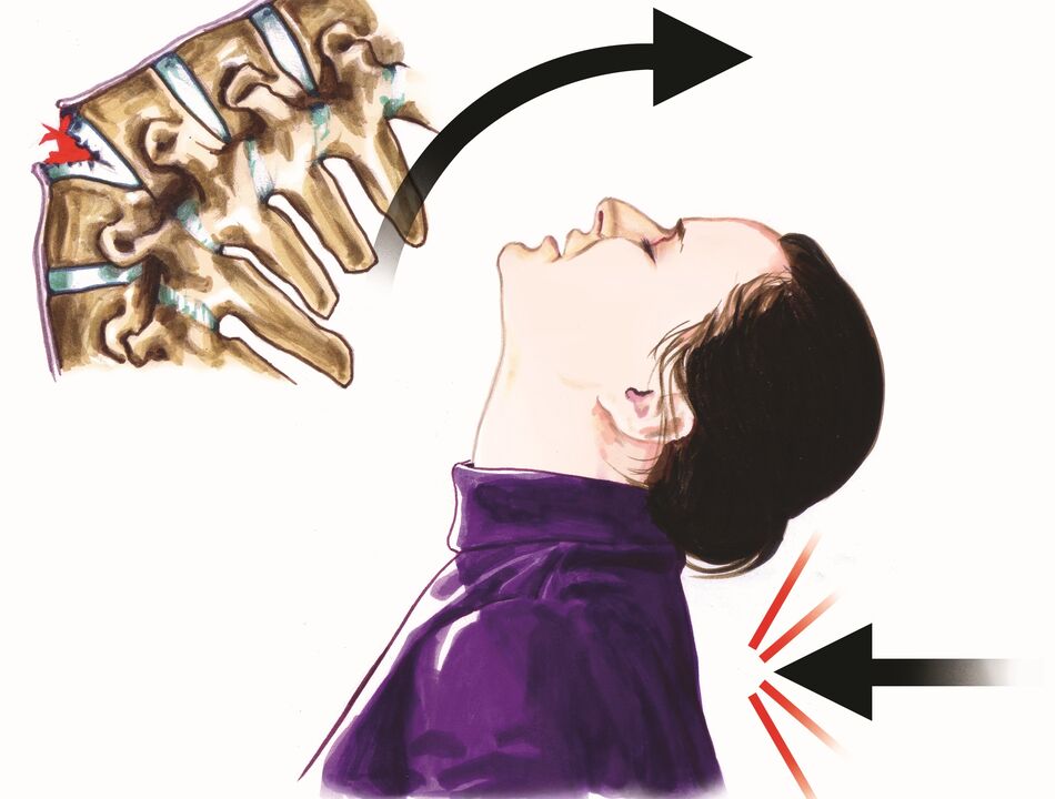 увреждане на гръбначния стълб като причина за болка във врата